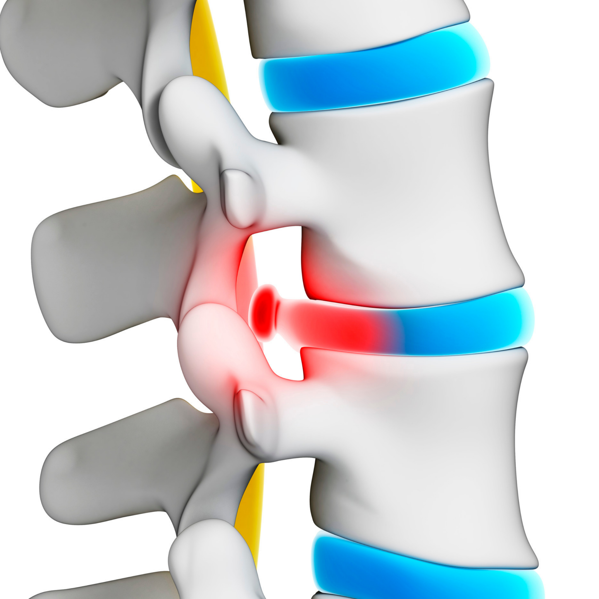 5 reasons you should treat your back pain with Spinal Decompression Therapy